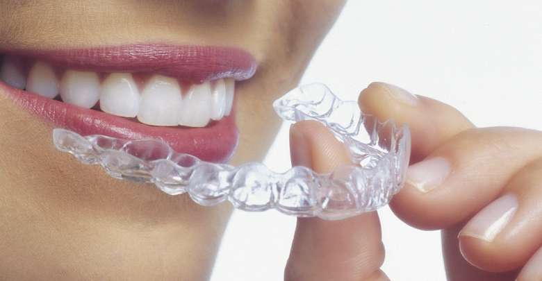 Clear Aligners